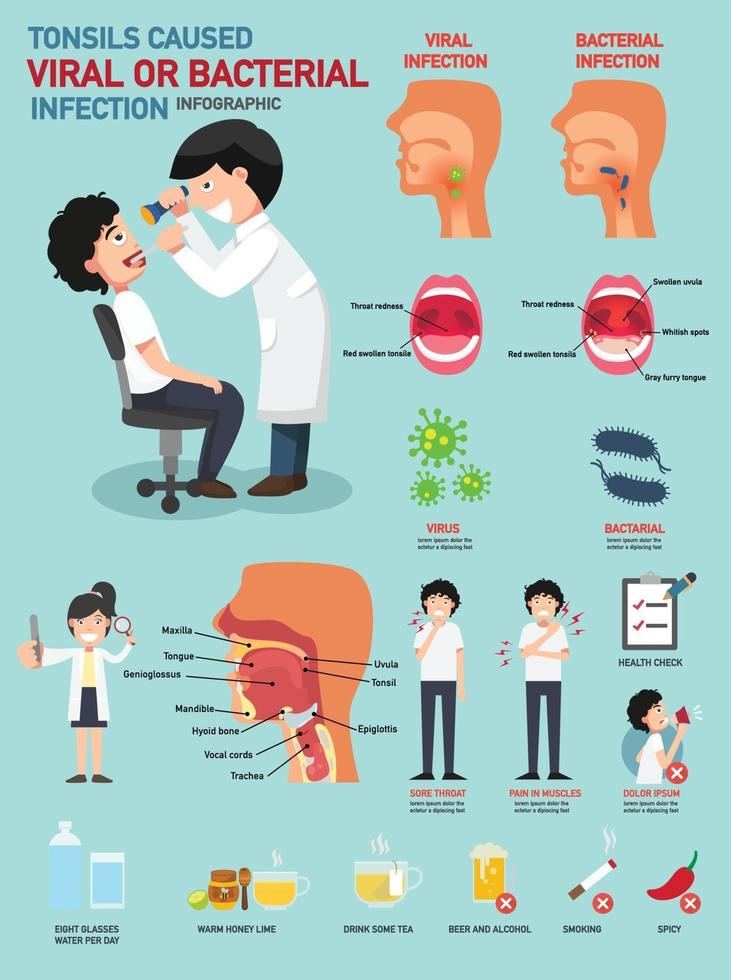 las amígdalas causaron una infección viral o bacteriana vector