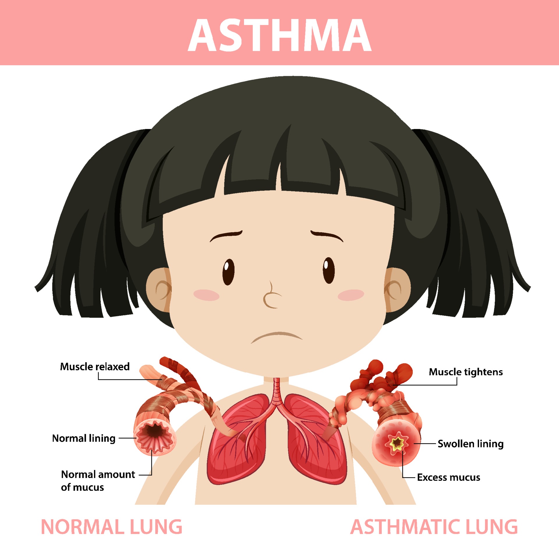 Asthma diagram with normal lung and asthmatic lung 3215054 Vector Art
