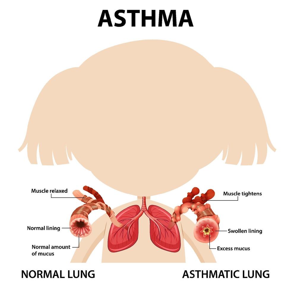 diagrama de asma con pulmón normal y pulmón asmático vector