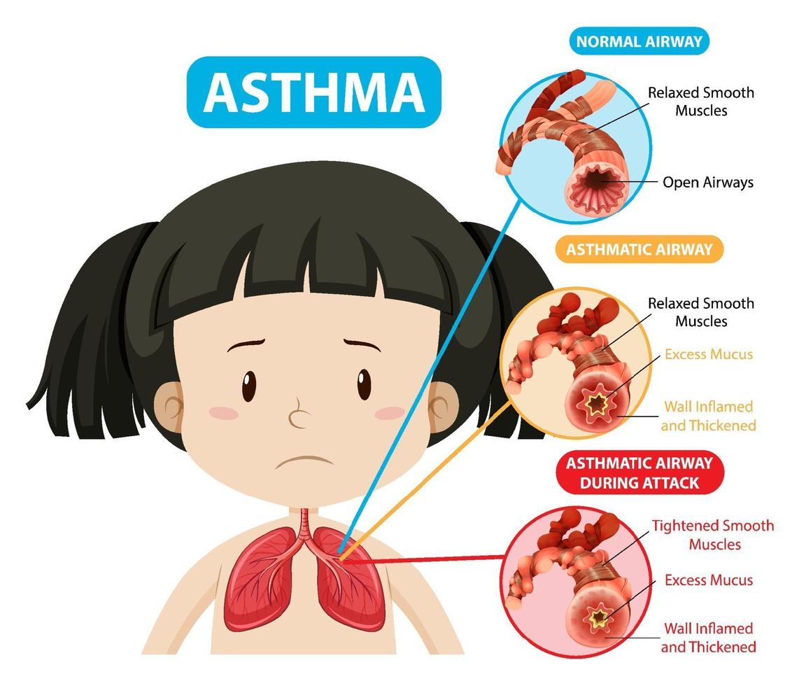 diagrama de asma con vía aérea normal y vía aérea asmática vector