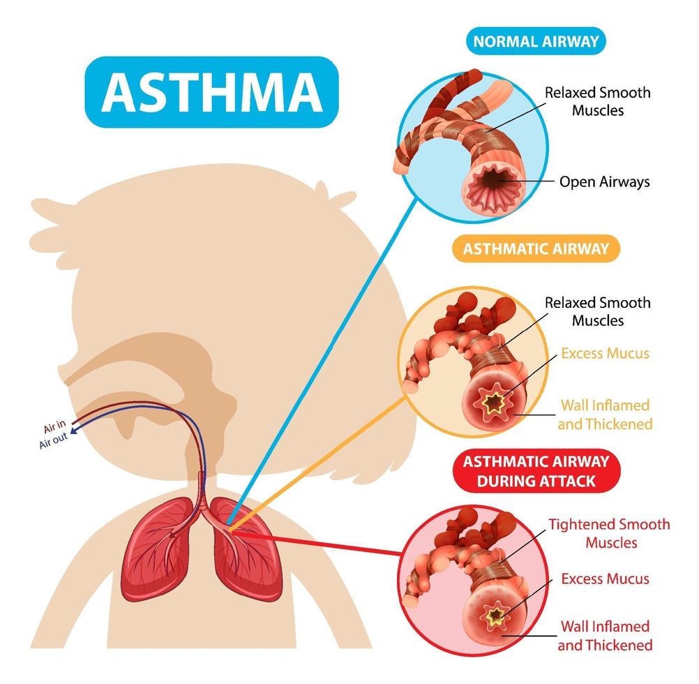 Asthma diagram with normal airway and asthmatic airway vector