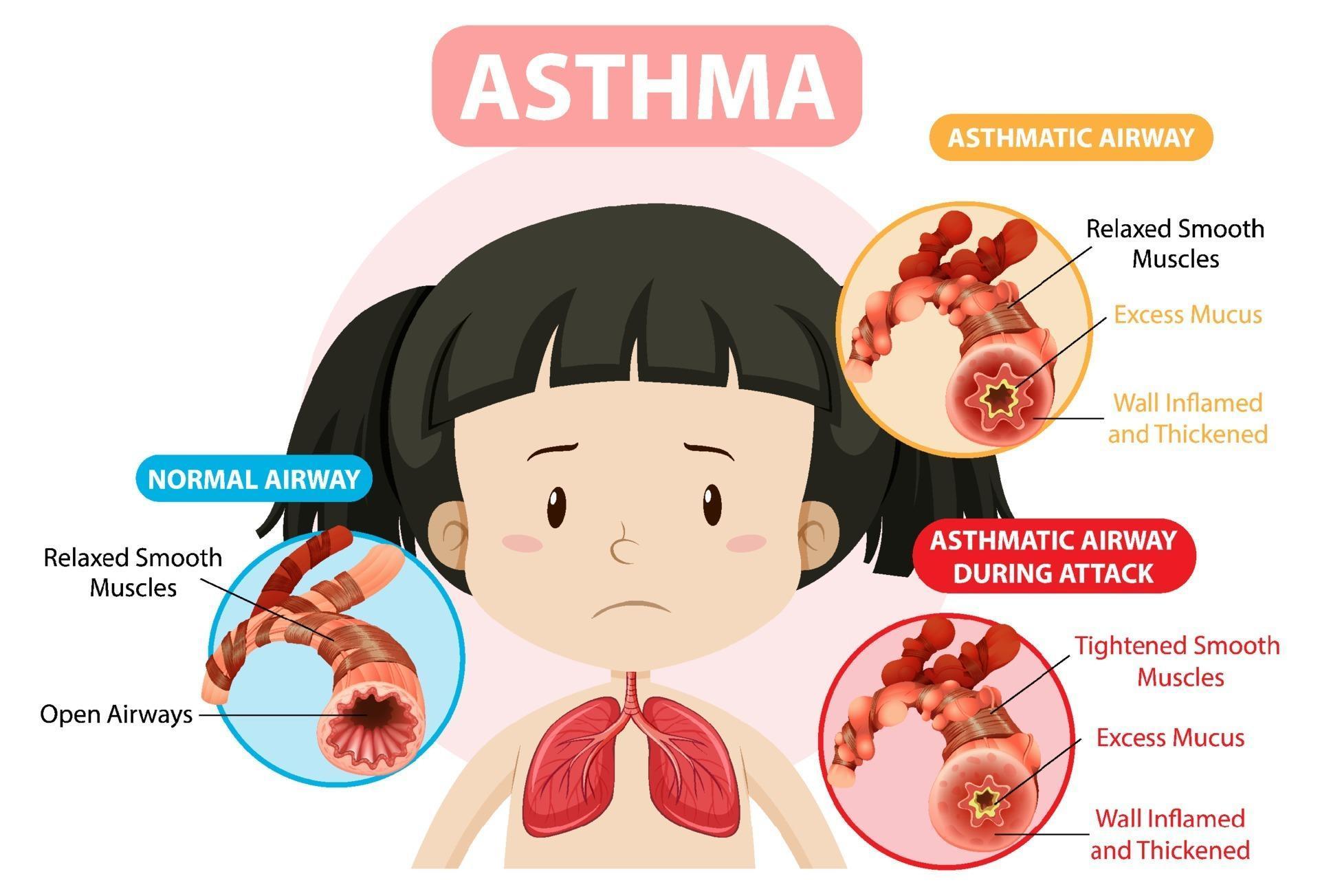 Asthma diagram with normal airway and asthmatic airway 3234343 Vector
