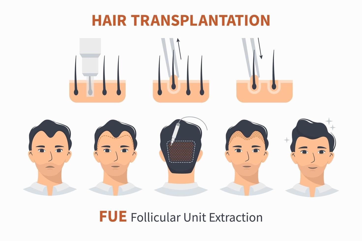 Stages of hair transplantation FUE Unit Extraction 3238386 Vector Art at  Vecteezy