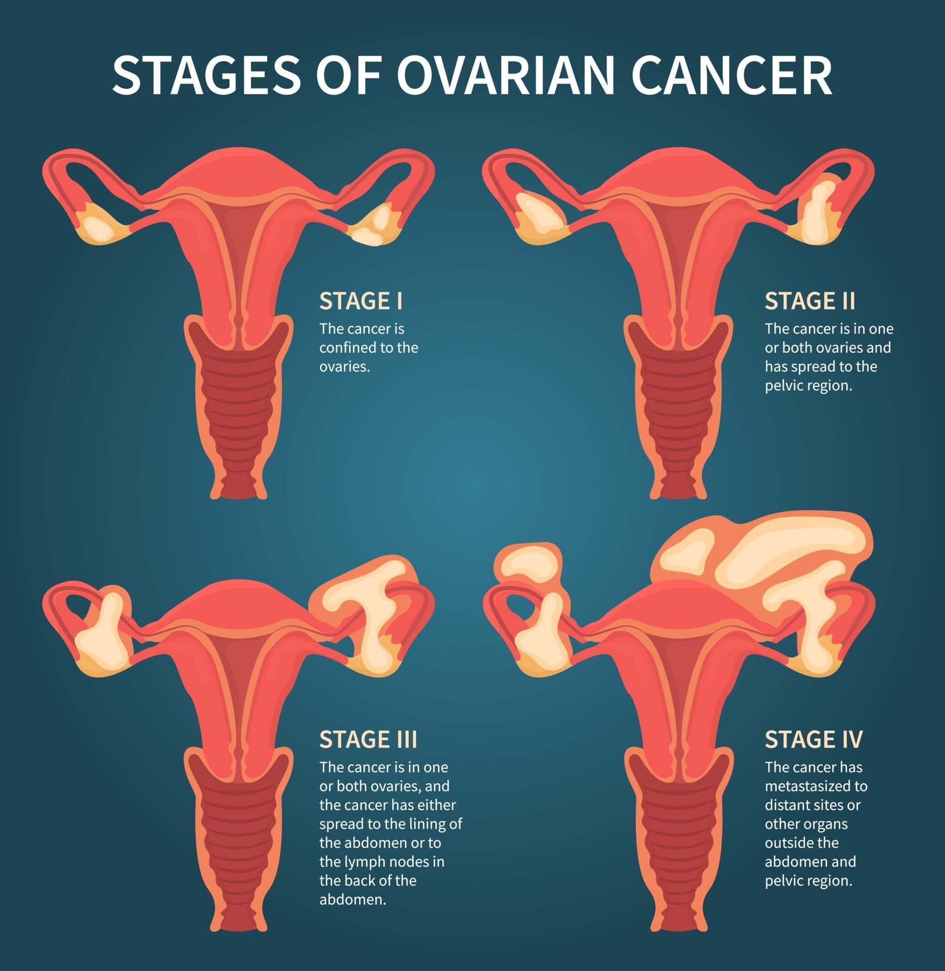 Stages Of Womans Ovarian Cancer Dark Blue Scheme Vector Art At