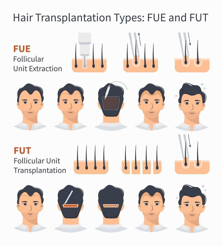 tipos de trasplante de cabello fue y fut vector