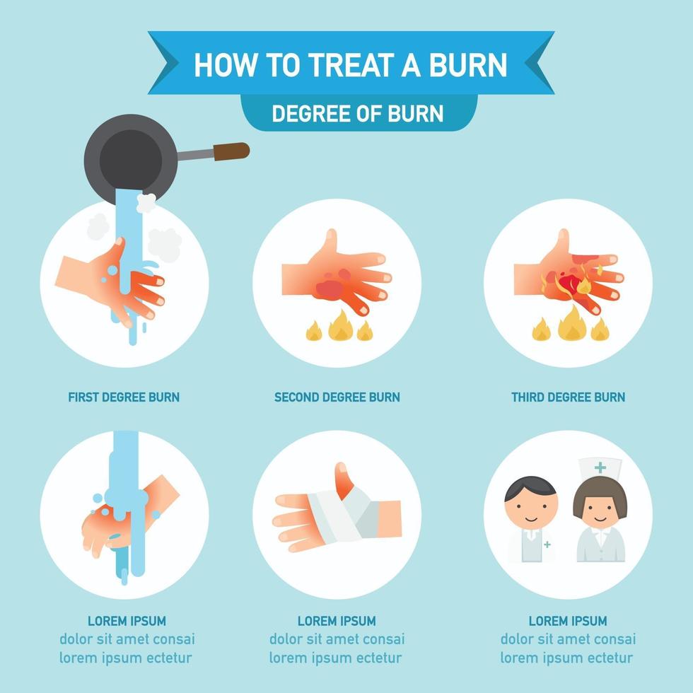 How to treat a burn infographic,vector illustration vector