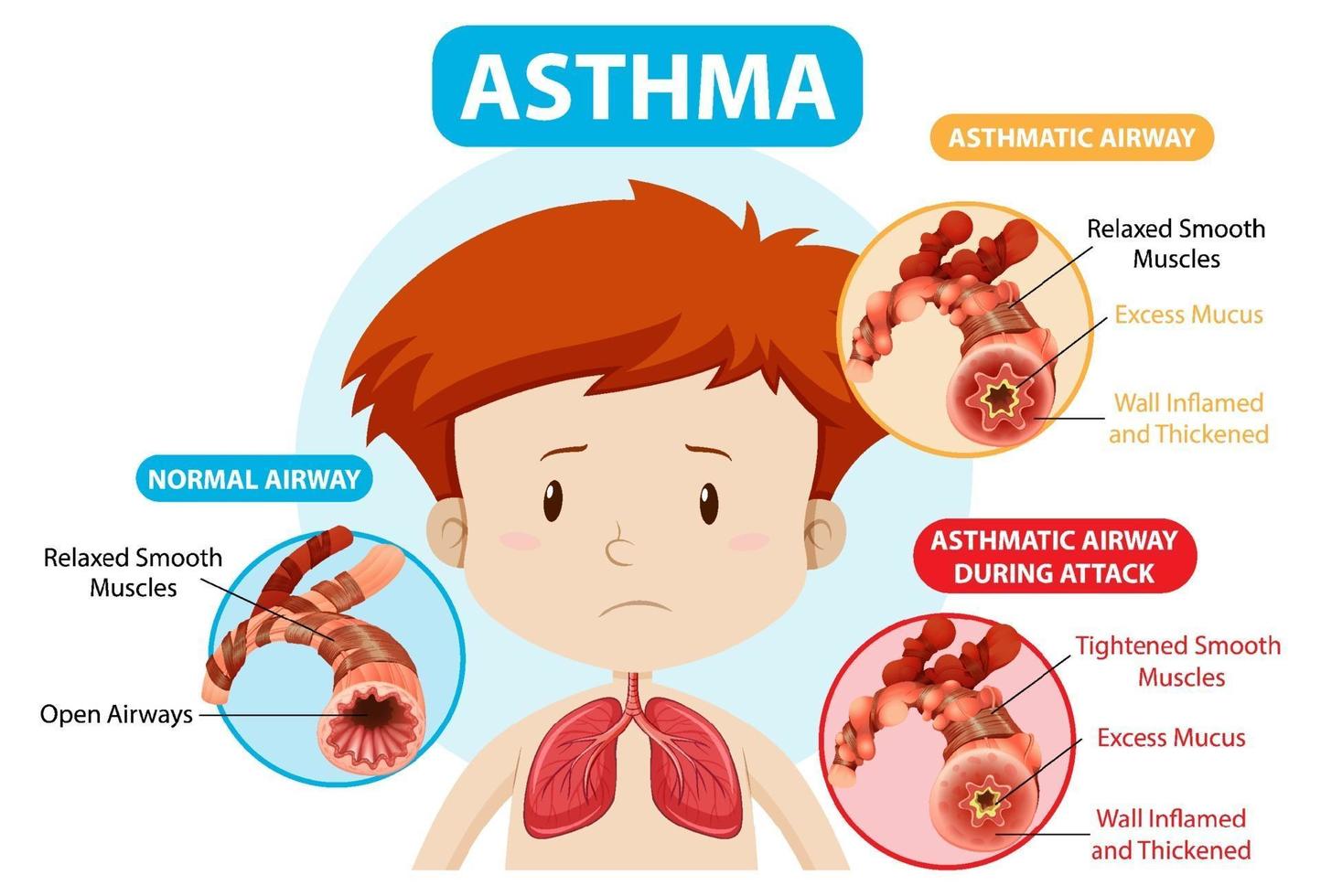 Asthma diagram with normal airway and asthmatic airway vector