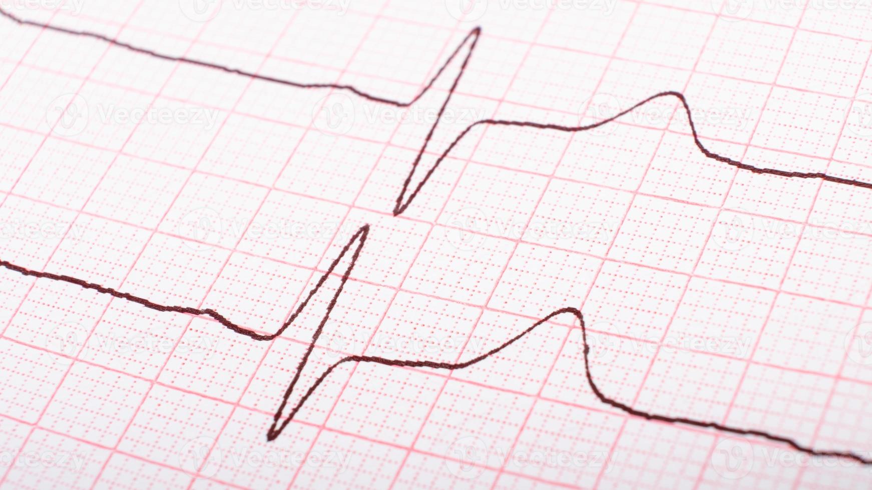 cardiograma de impulsos cardíacos, concepto de enfermedad hipertónica. foto