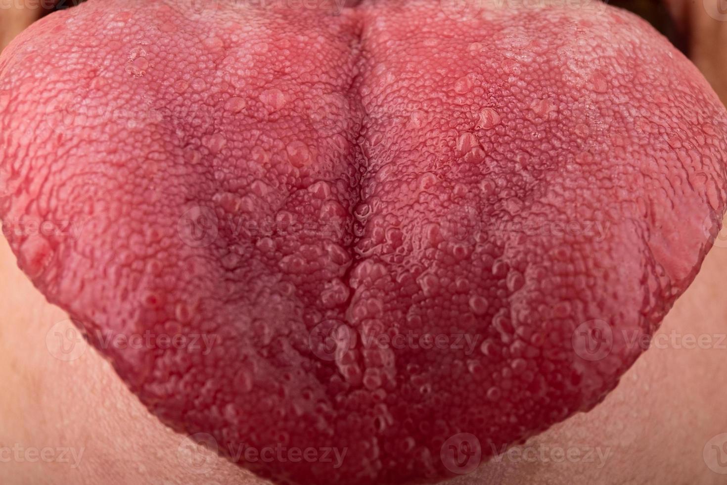 Cracks in the tongue Candida diseases, red tongue stomatitis closeup. photo