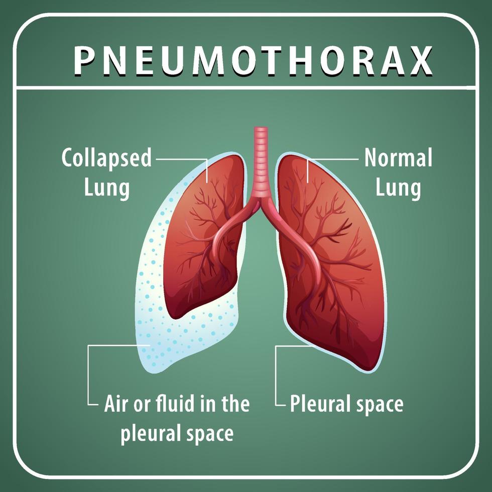 diagrama de neumotórax con pulmón colapsado y pulmón normal vector