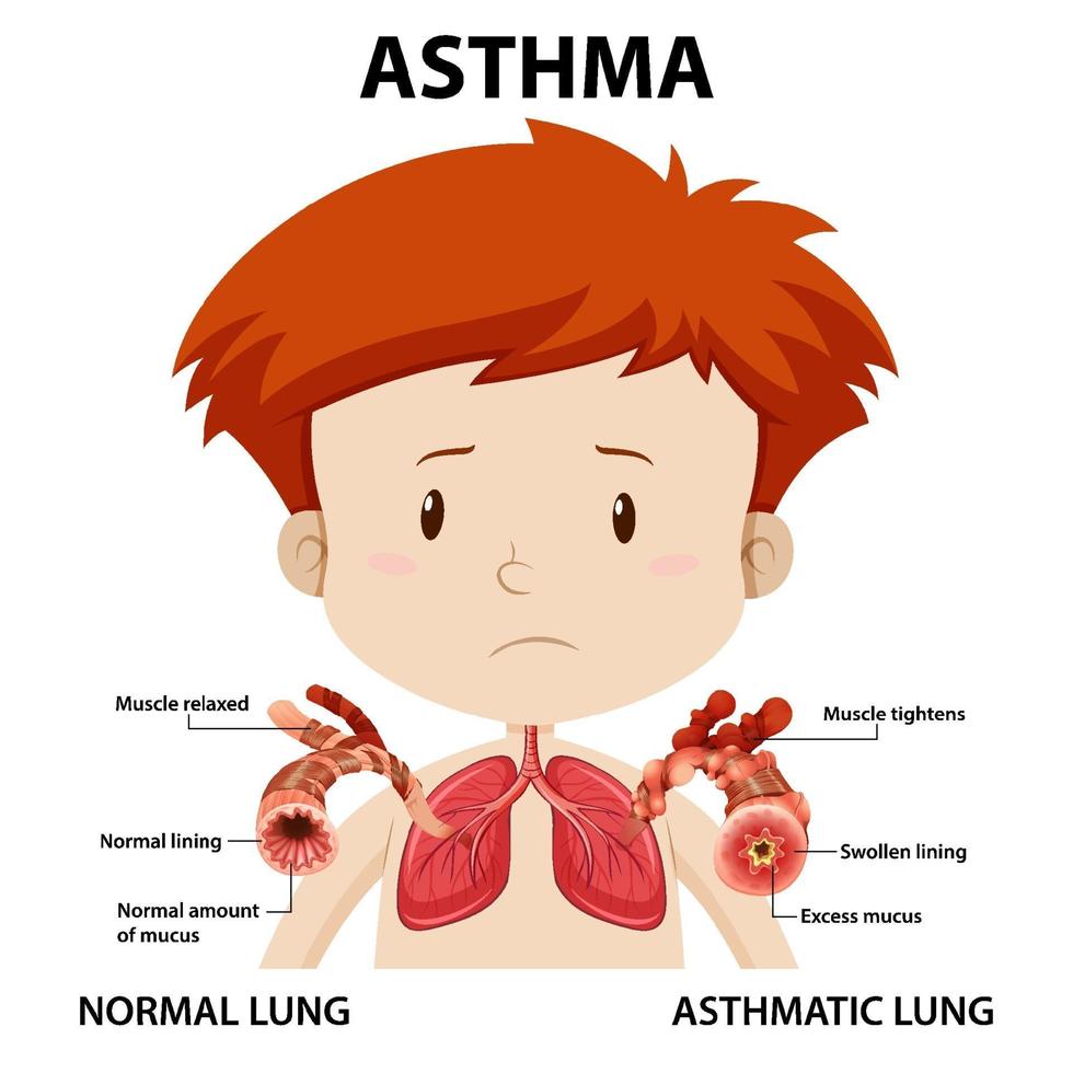 diagrama de asma con pulmón normal y pulmón asmático vector