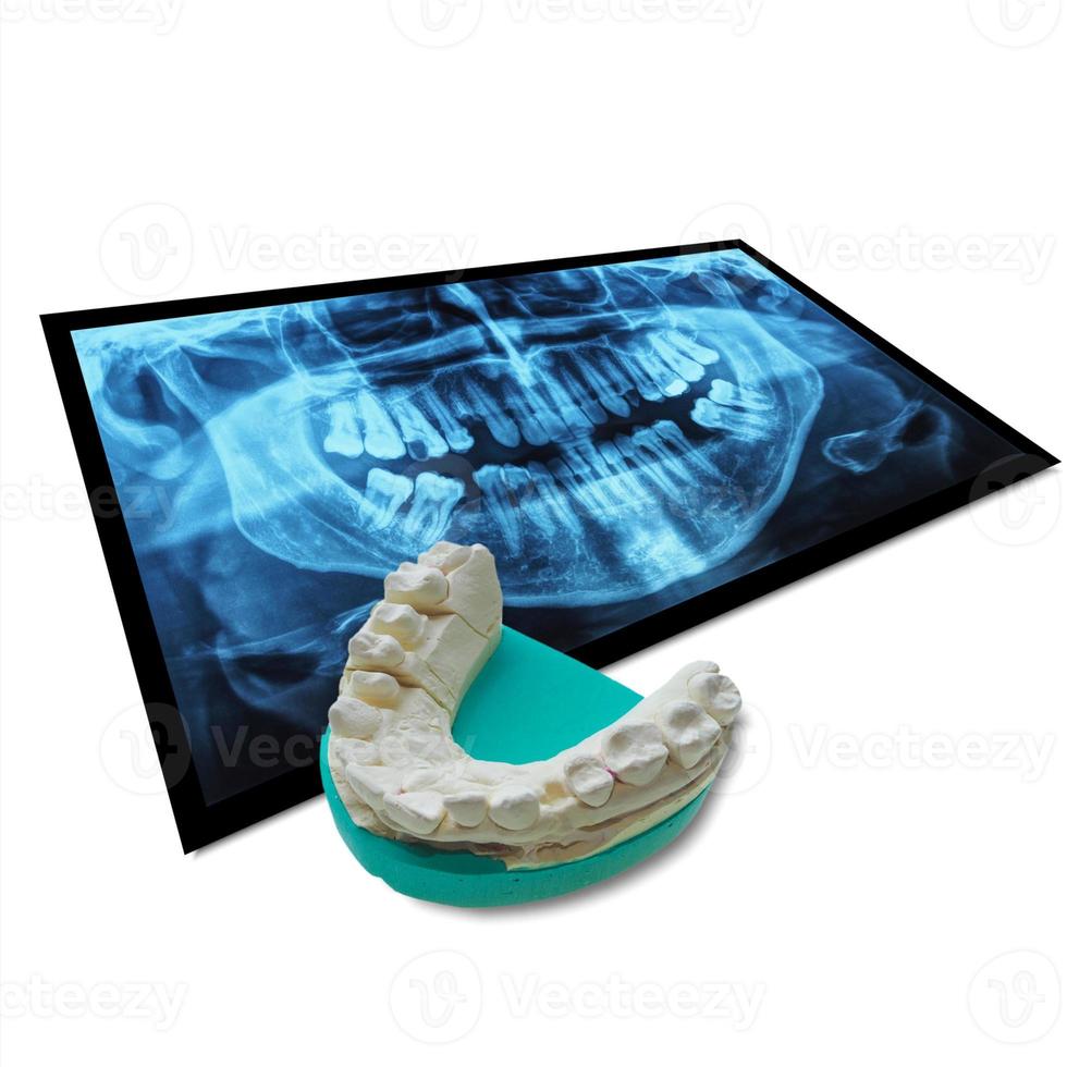 Xray of teeth with positive teeth cast photo