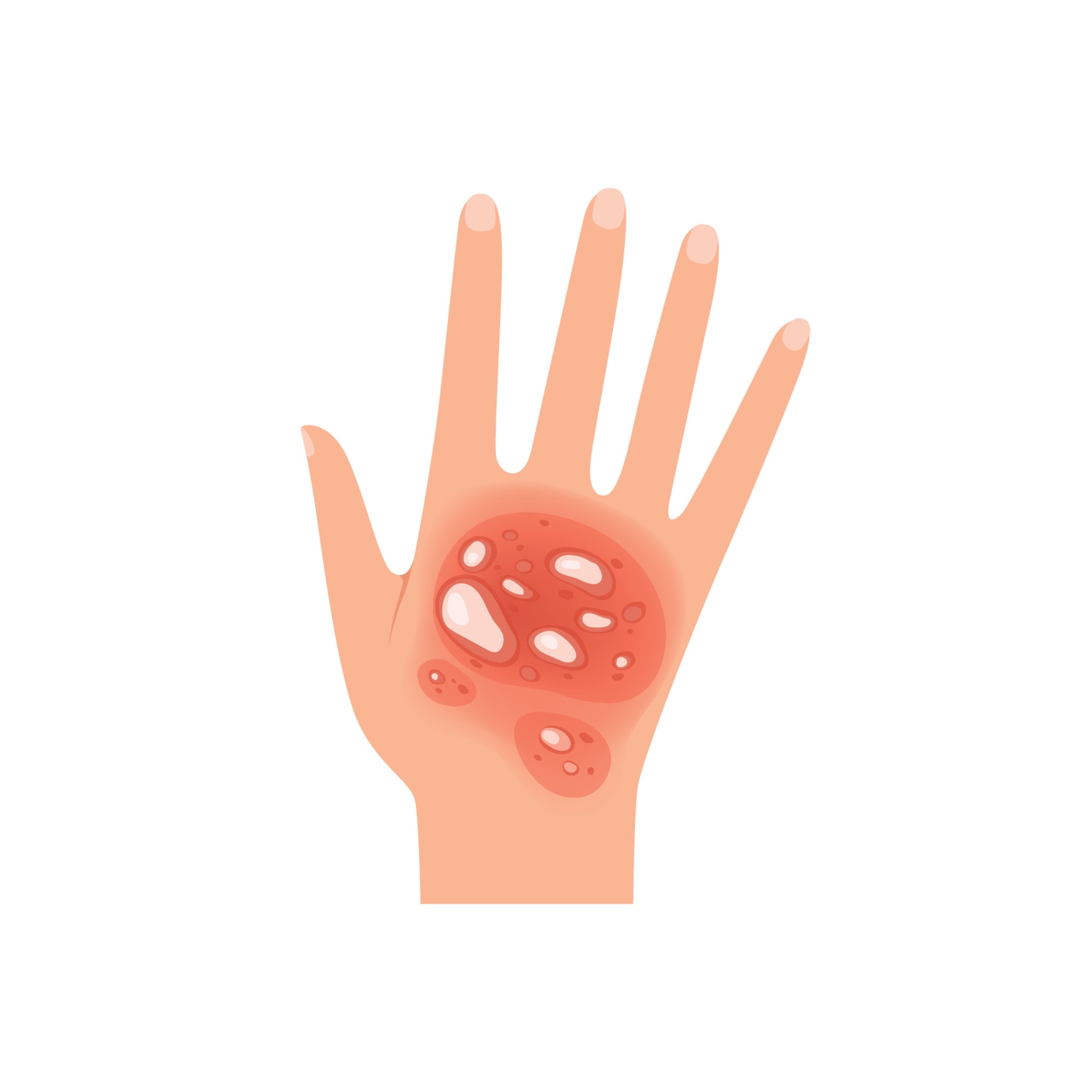 Skin Burn Vector Art, Icons, and Graphics for Free Download