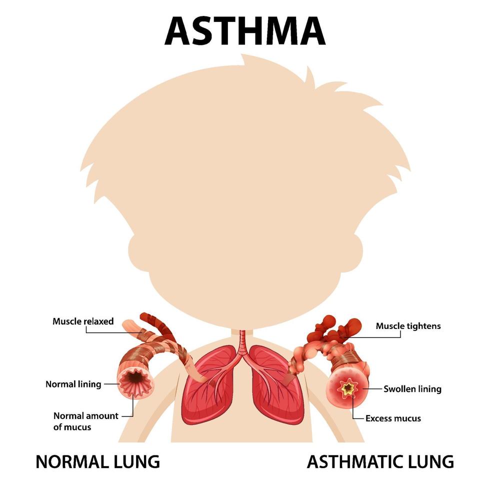 diagrama de asma bronquial con pulmón normal y pulmón asmático vector