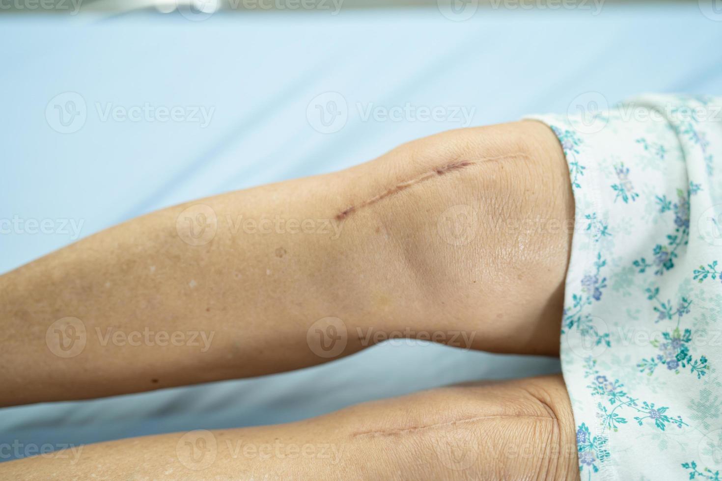 Paciente mujer mayor asiática mostrar sus cicatrices quirúrgico articulación total de la rodilla foto