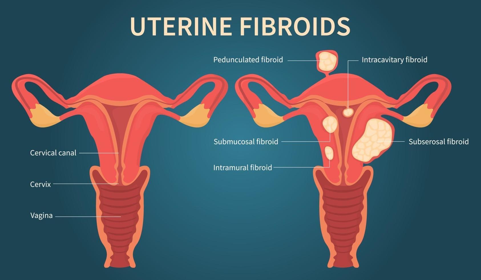 Uterine fibroids scheme on dark blue background vector