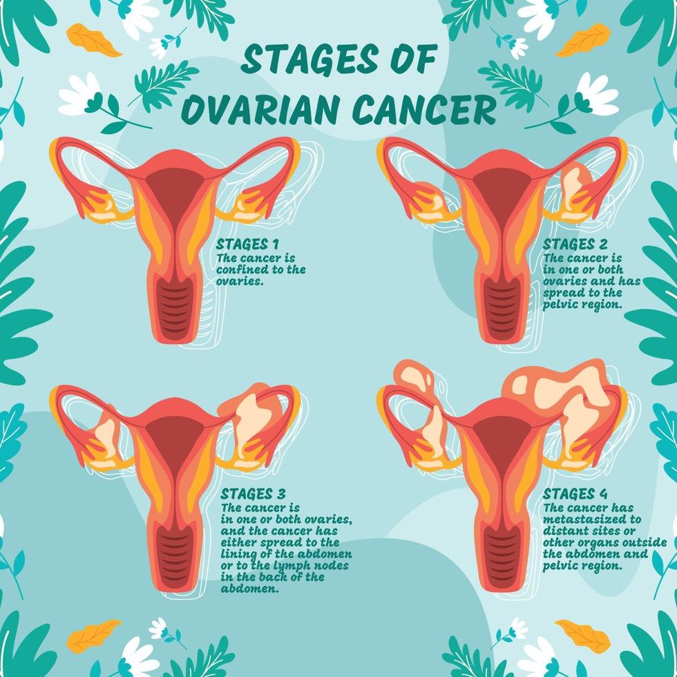Ovarian Cancer Stage Infographic vector
