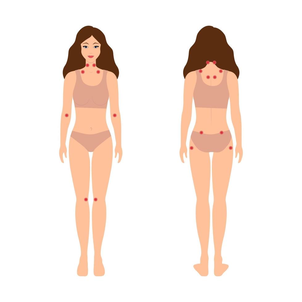 Fibromyalgia trigger points, tender point map. vector