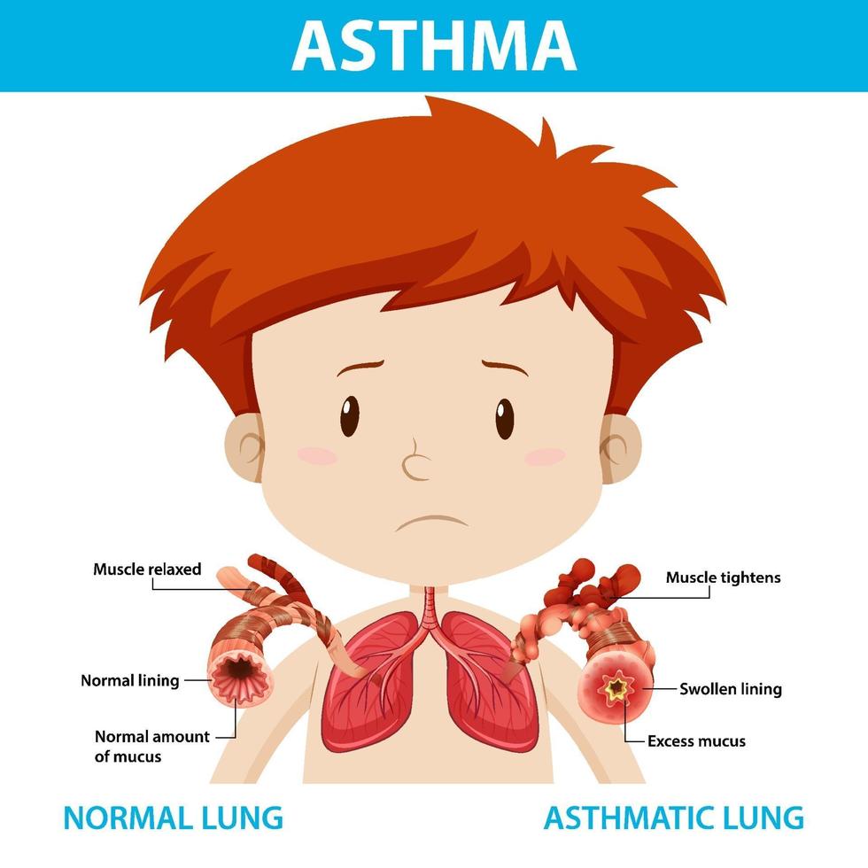 diagrama de asma con pulmón normal y pulmón asmático vector