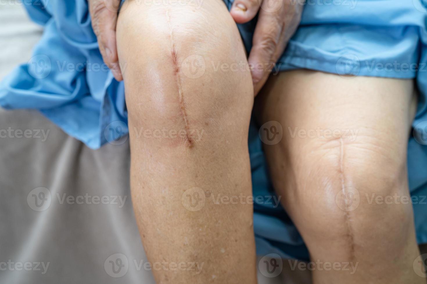 Paciente mayor asiático muestra sus cicatrices reemplazo quirúrgico de la articulación de la rodilla foto