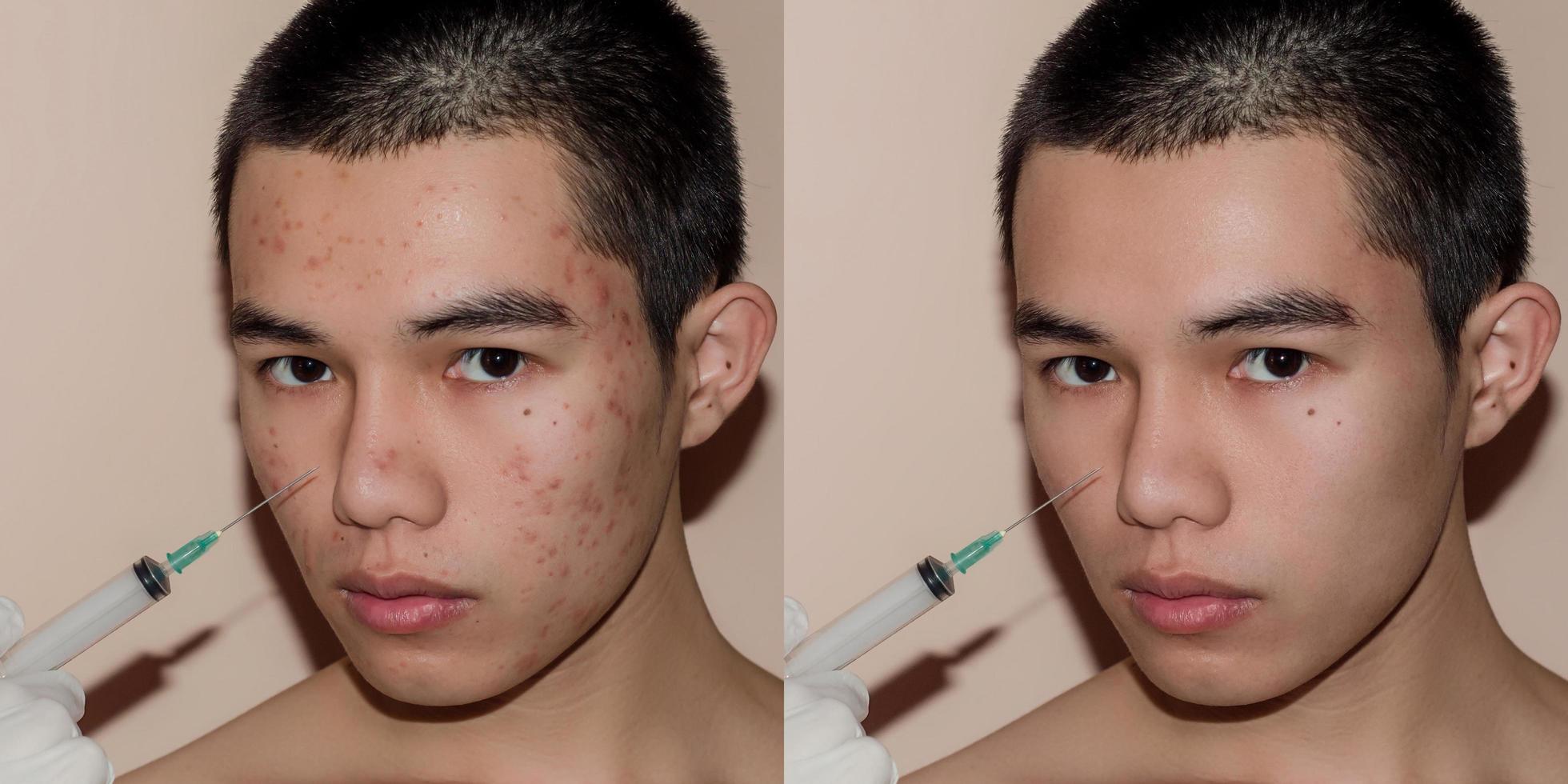 Young man with before and after treatment from acne and pimple. photo