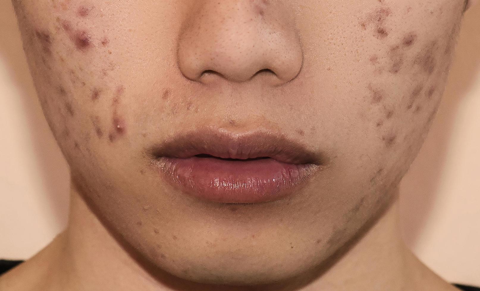Cerca de acné en la piel, acné en la cara causado por hormonas. foto