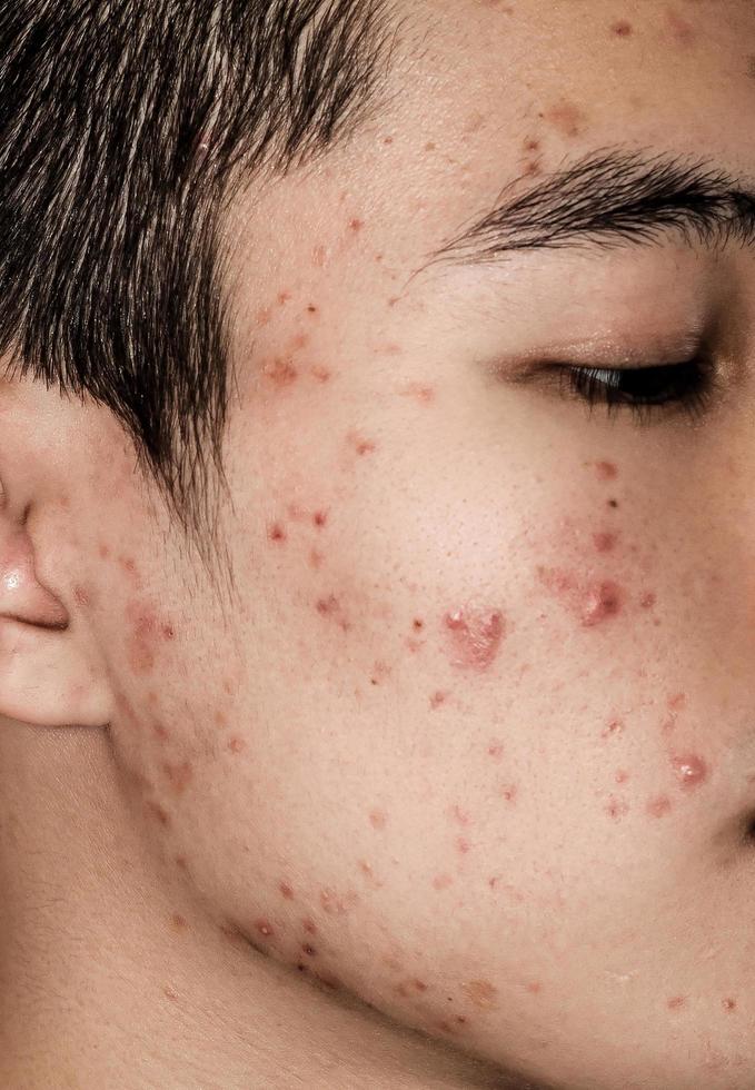 Close up of acne on the skin, Acne on the face caused by Hormone. photo