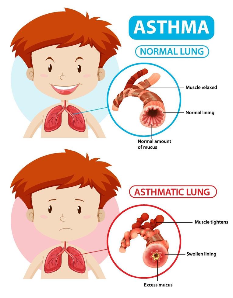 diagrama de asma con pulmón normal y pulmón asmático vector