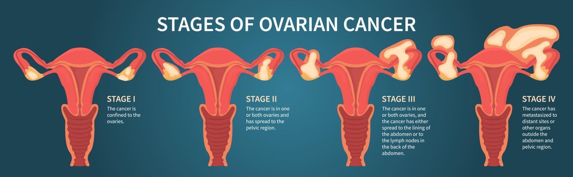 Four stages of ovarian cancer dark blue scheme vector