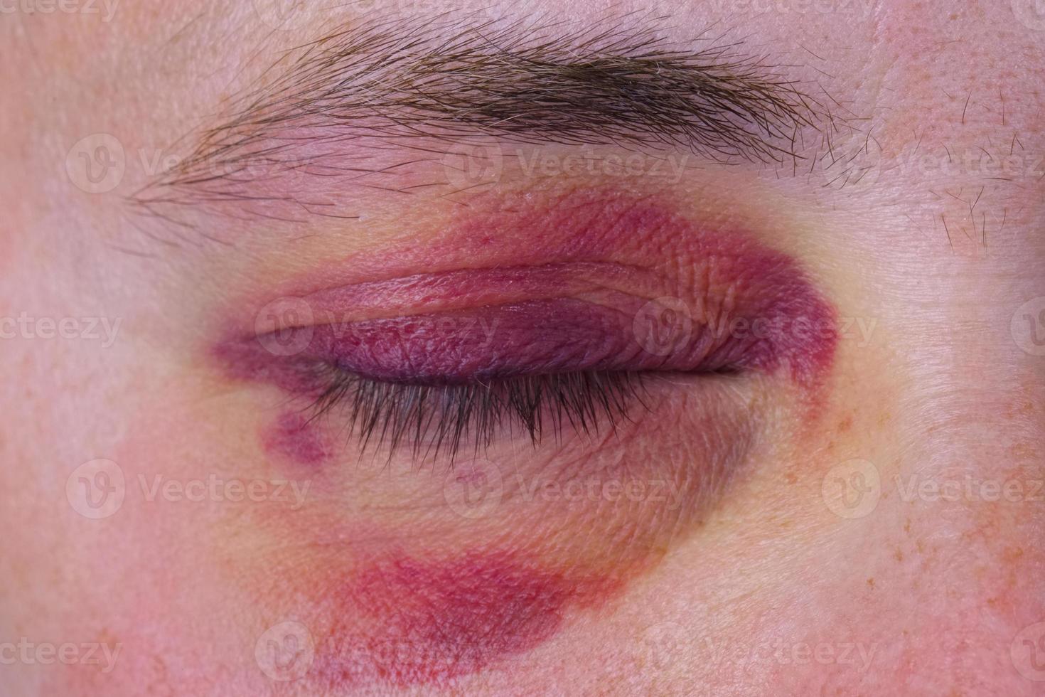 Human eye with a purple bruise photo