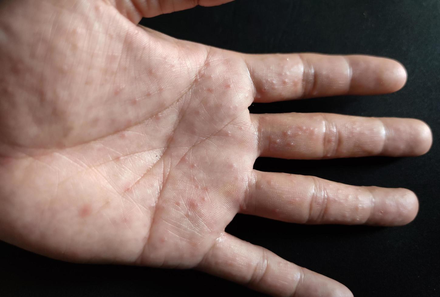 Dyshidrotic Eczema is an allergic skin condition. photo