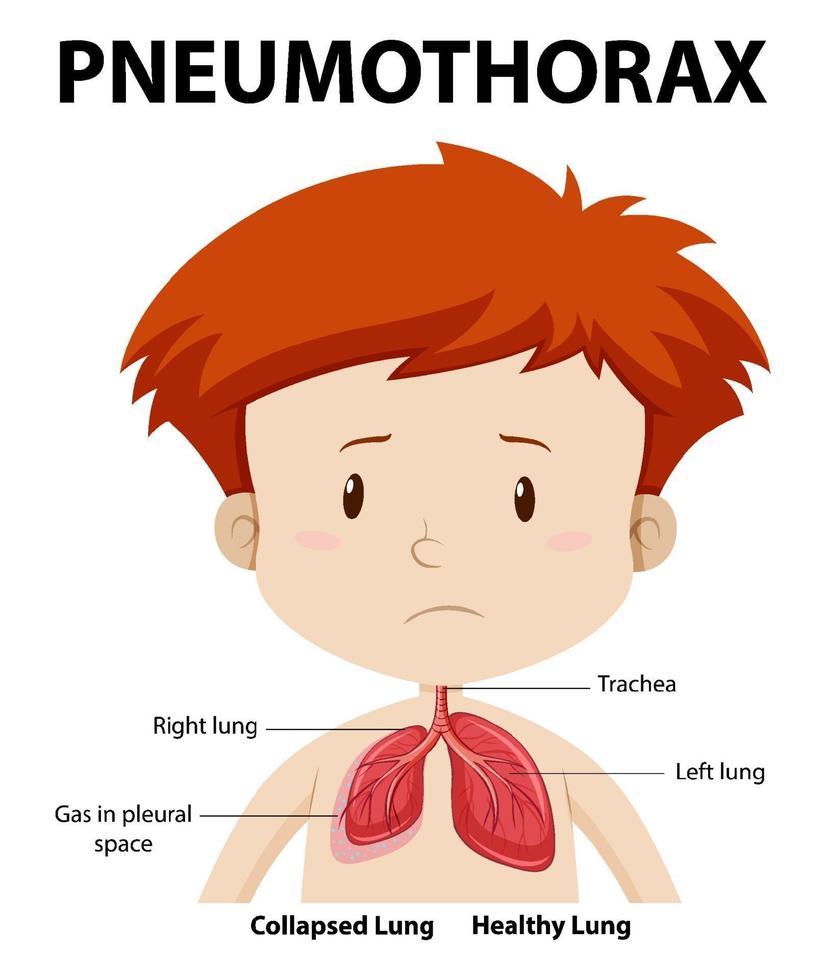 Pneumothorax diagram of human anatomy vector