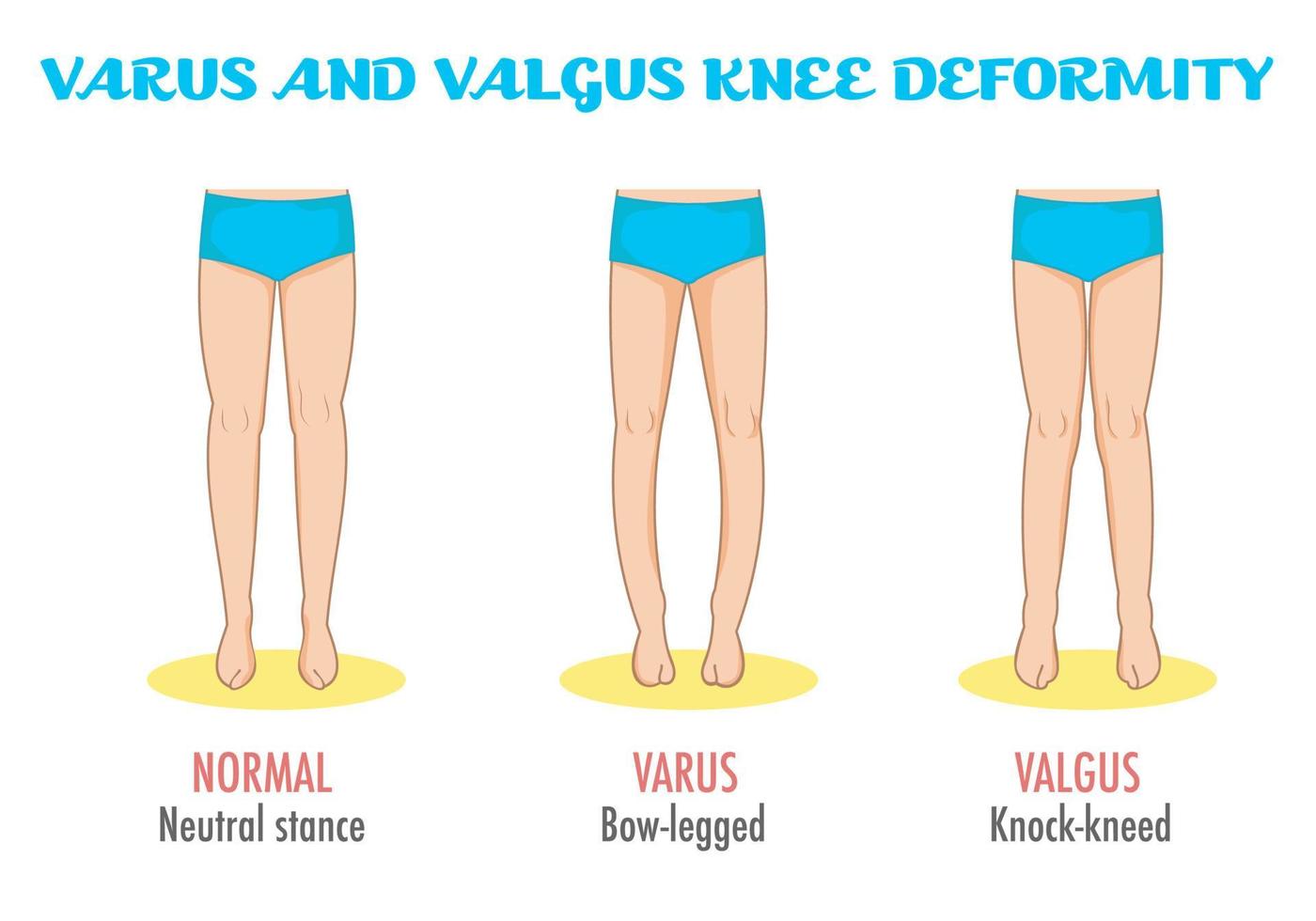 Valgus and varus foot standing vector