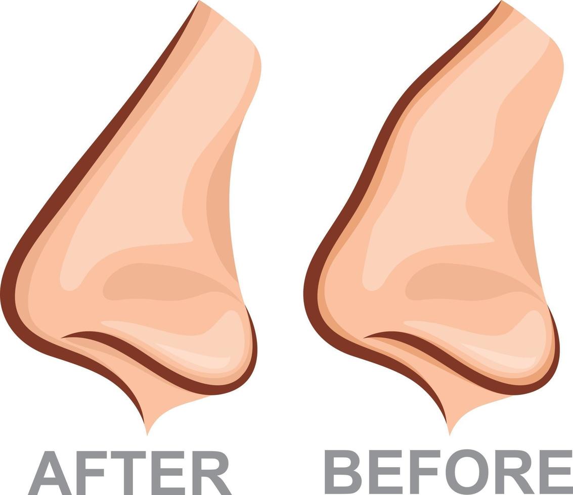 Nose Before and After Rhinoplasty vector