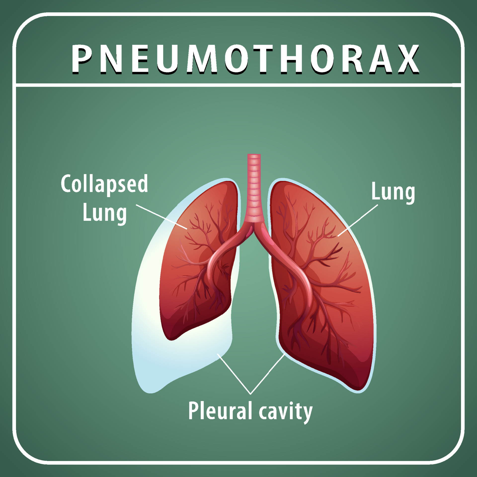 Pneumothorax diagram with collapsed lung and normal lung 3509362 Vector