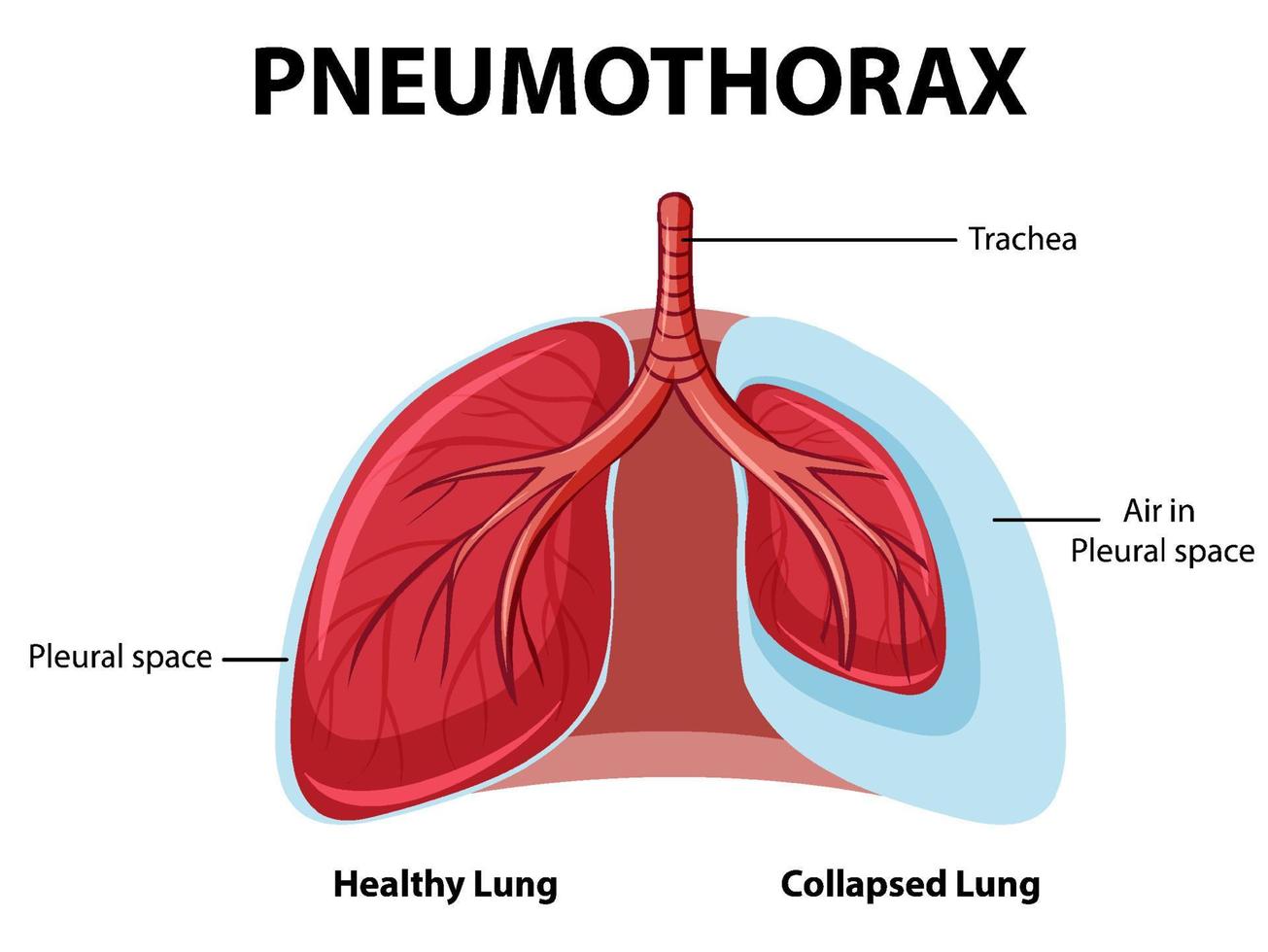 Pneumothorax diagram with collapsed lung and healthy lung vector