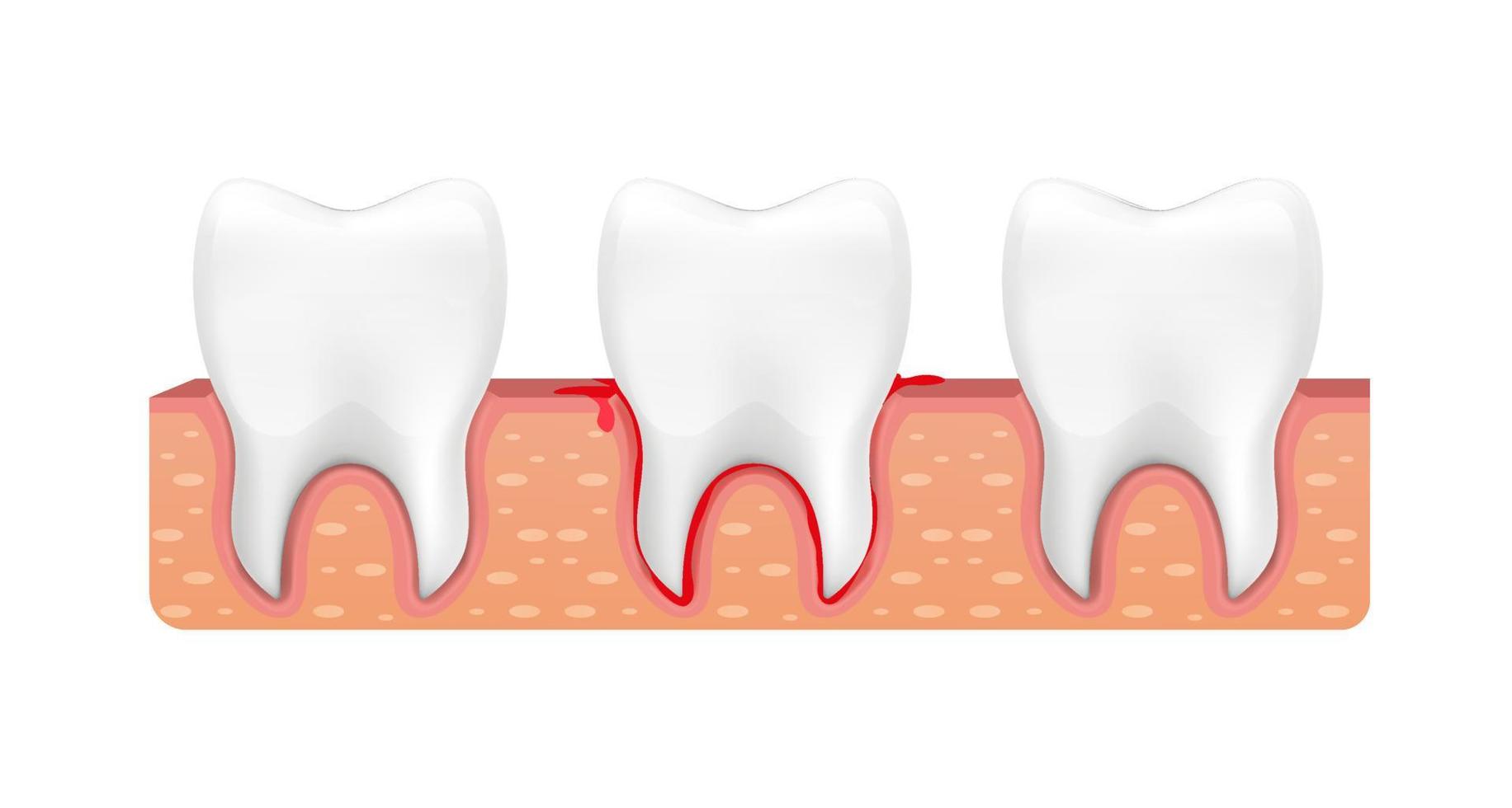 El diente está sangrando en la encía. dientes de sangre. vector