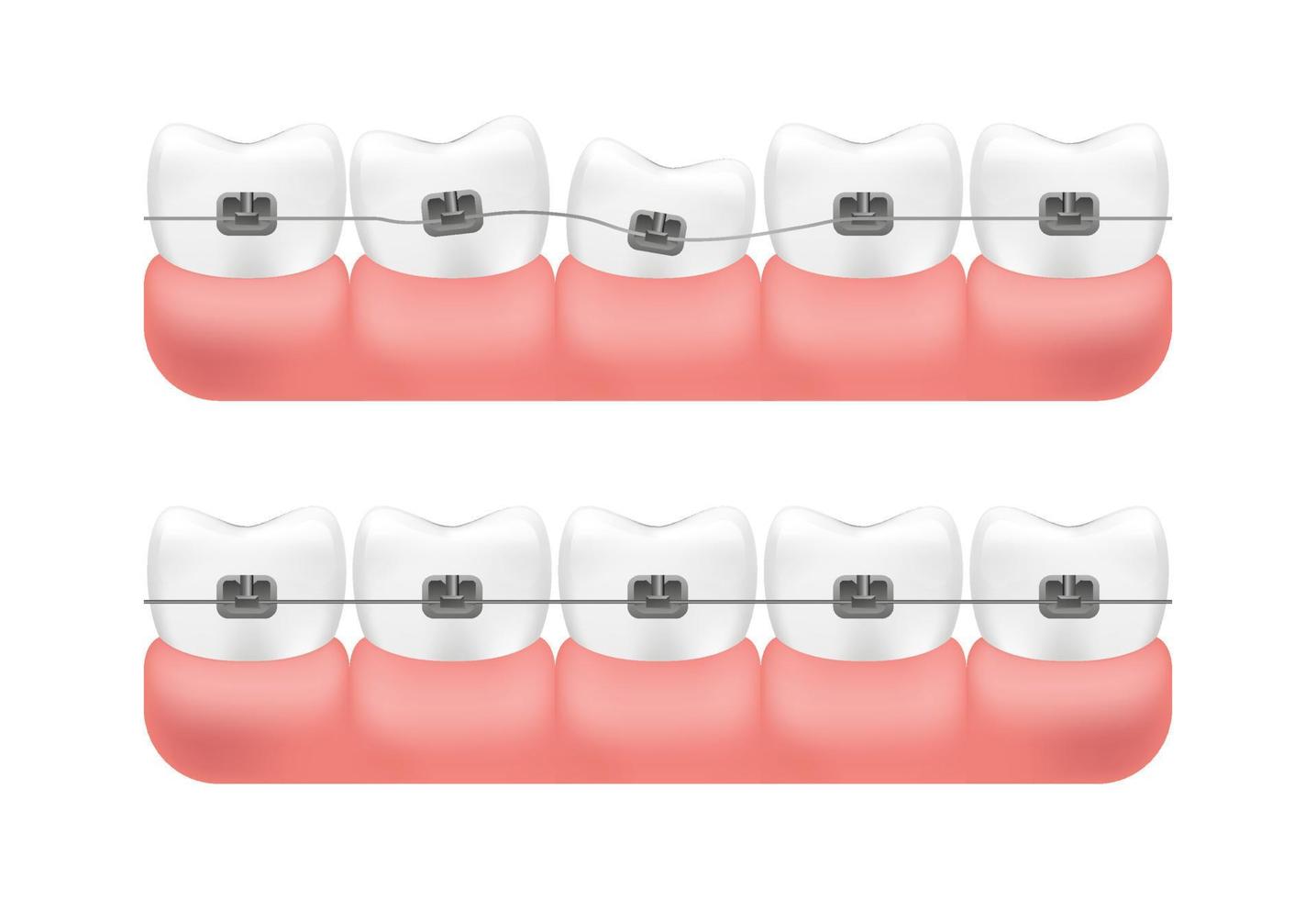 Bite correction with the help of braces system. Alignment of teeth. Vector. vector