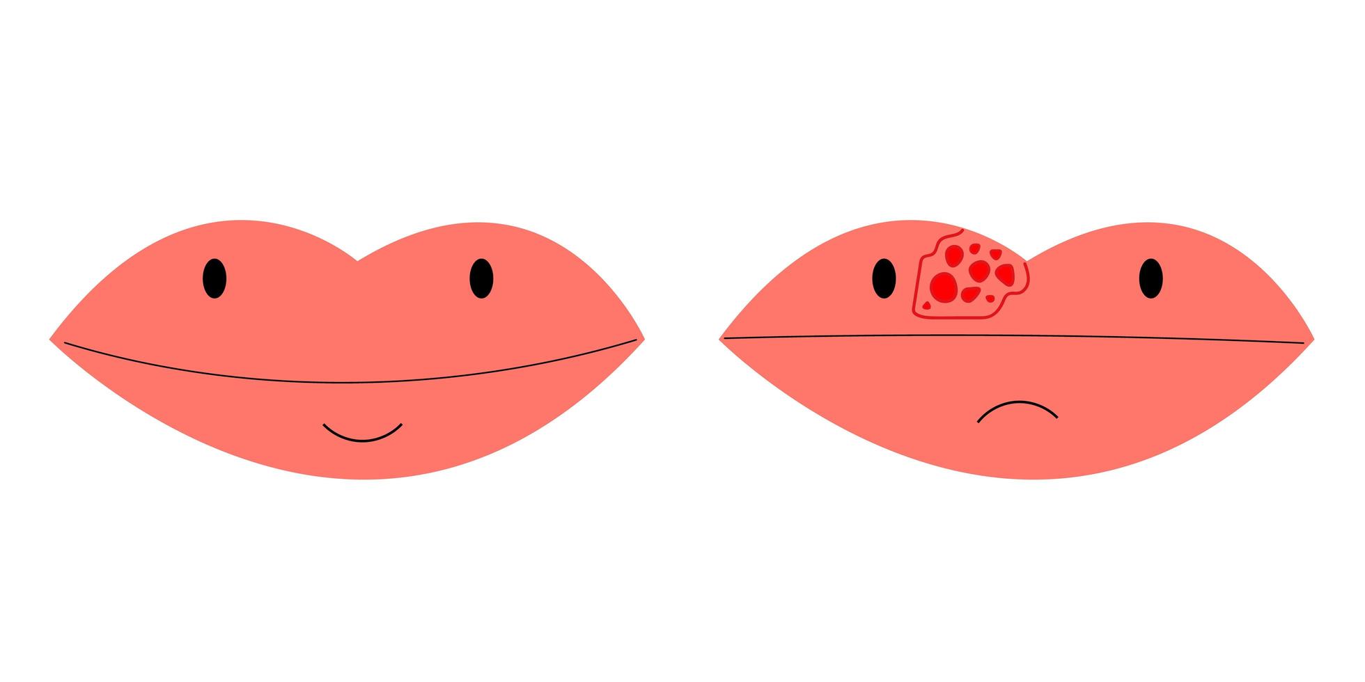 Primer plano de labios con herpes frío, dolor en el labio, ilustración vectorial vector