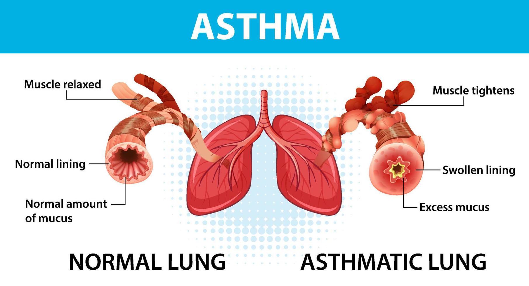 diagrama de asma bronquial con pulmón normal y pulmón asmático vector