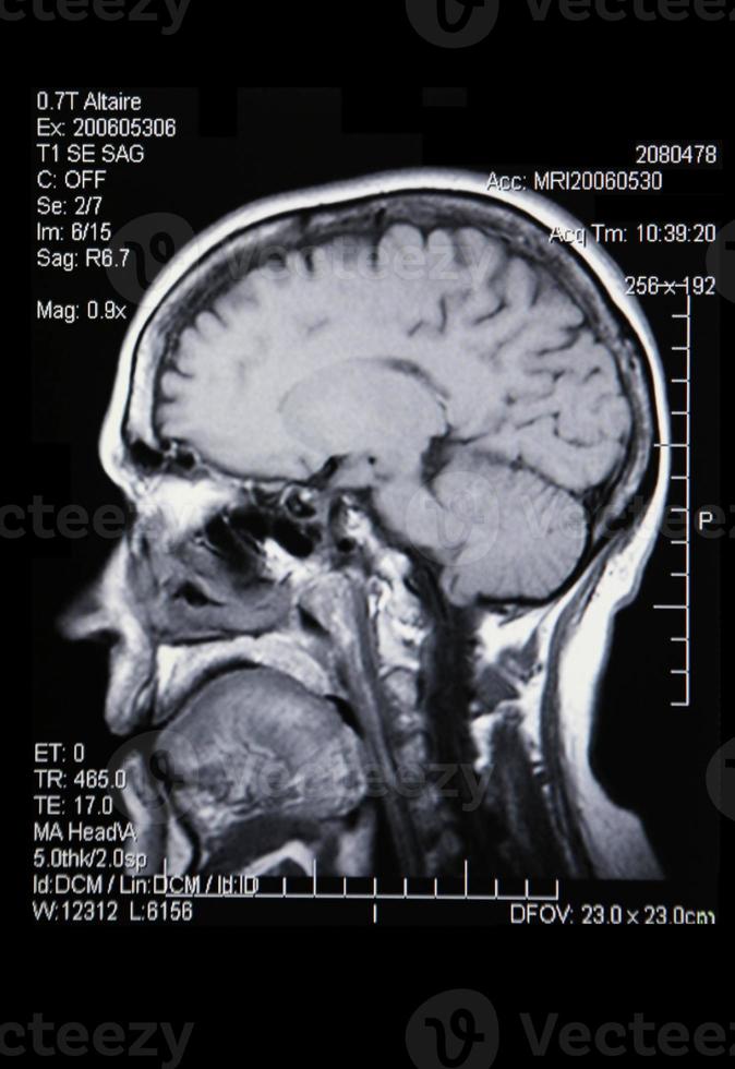 una resonancia magnética real de la vasculatura cerebral foto