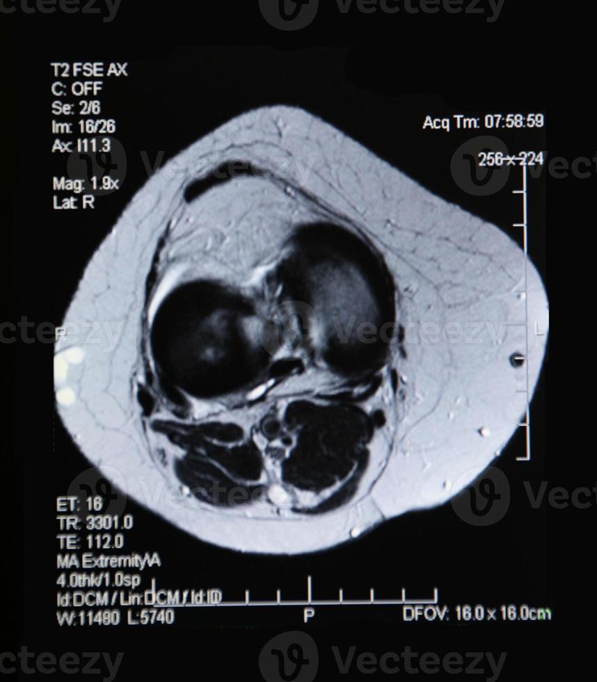 MRI of the Knee photo