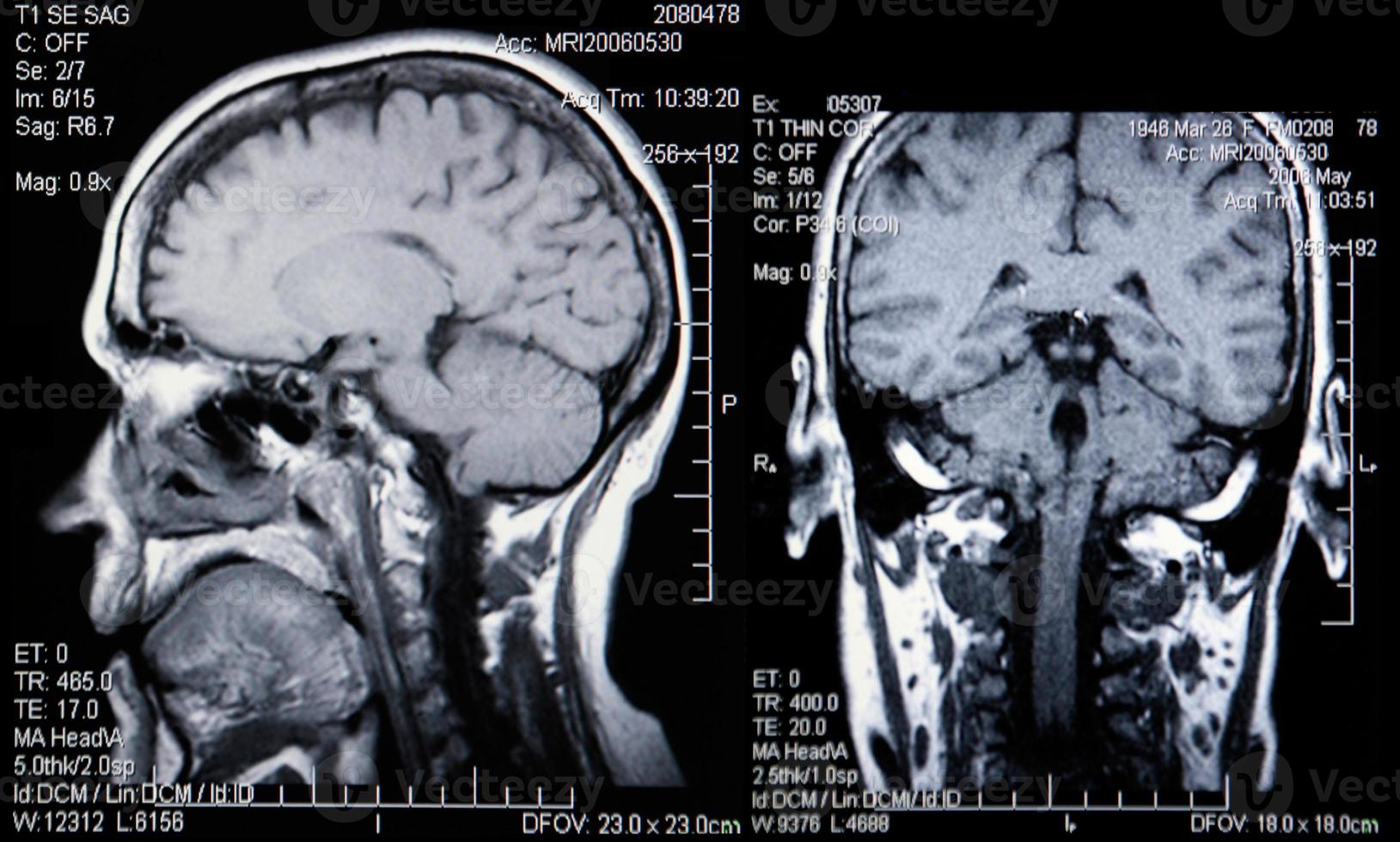 resonancias magnéticas reales de la cabeza y el cerebro foto