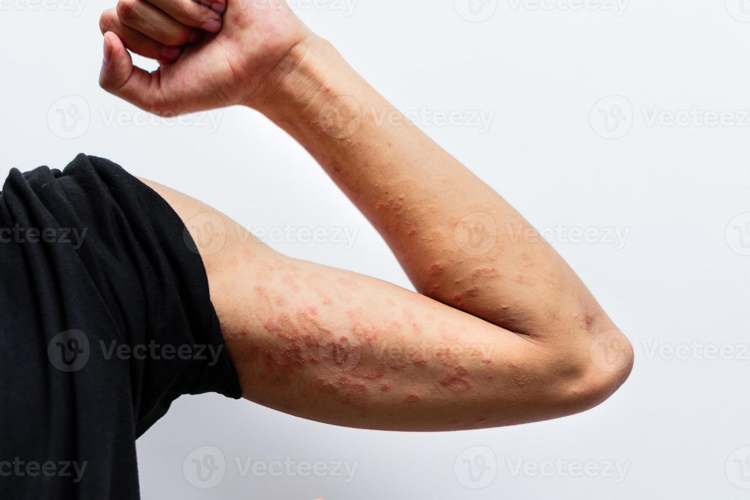 Close up dermatitis on man hand, allergic rash dermatitis eczema skin of a patient. Atopic dermatitis symptom skin detail texture, Fungus of skin. The concept of dermatology. photo