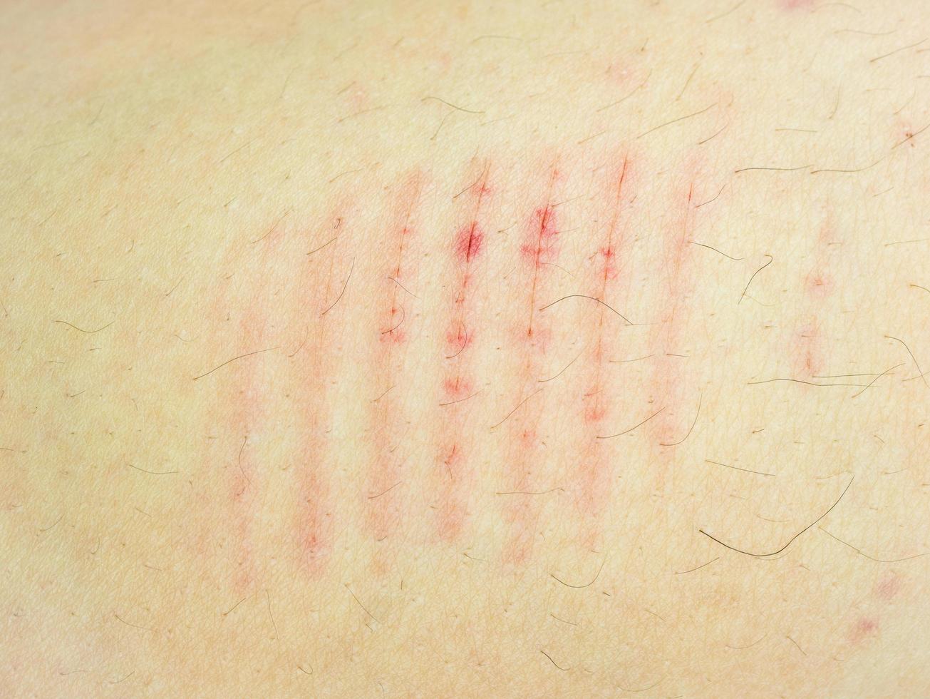 Close-up scar scratch on the human body photo