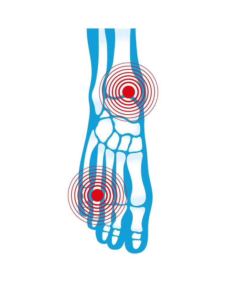 dolor reumatológico del pie vector