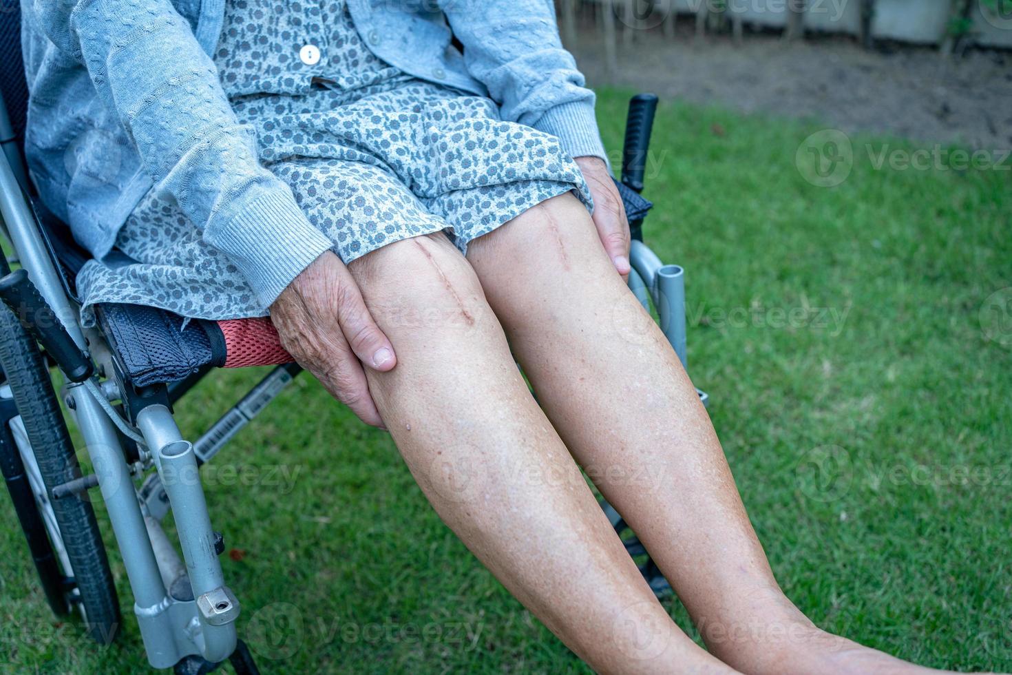 Asian senior or elderly old lady woman patient show her scars surgical total knee joint replacement Suture wound surgery arthroplasty on bed in nursing hospital ward, healthy strong medical concept. photo