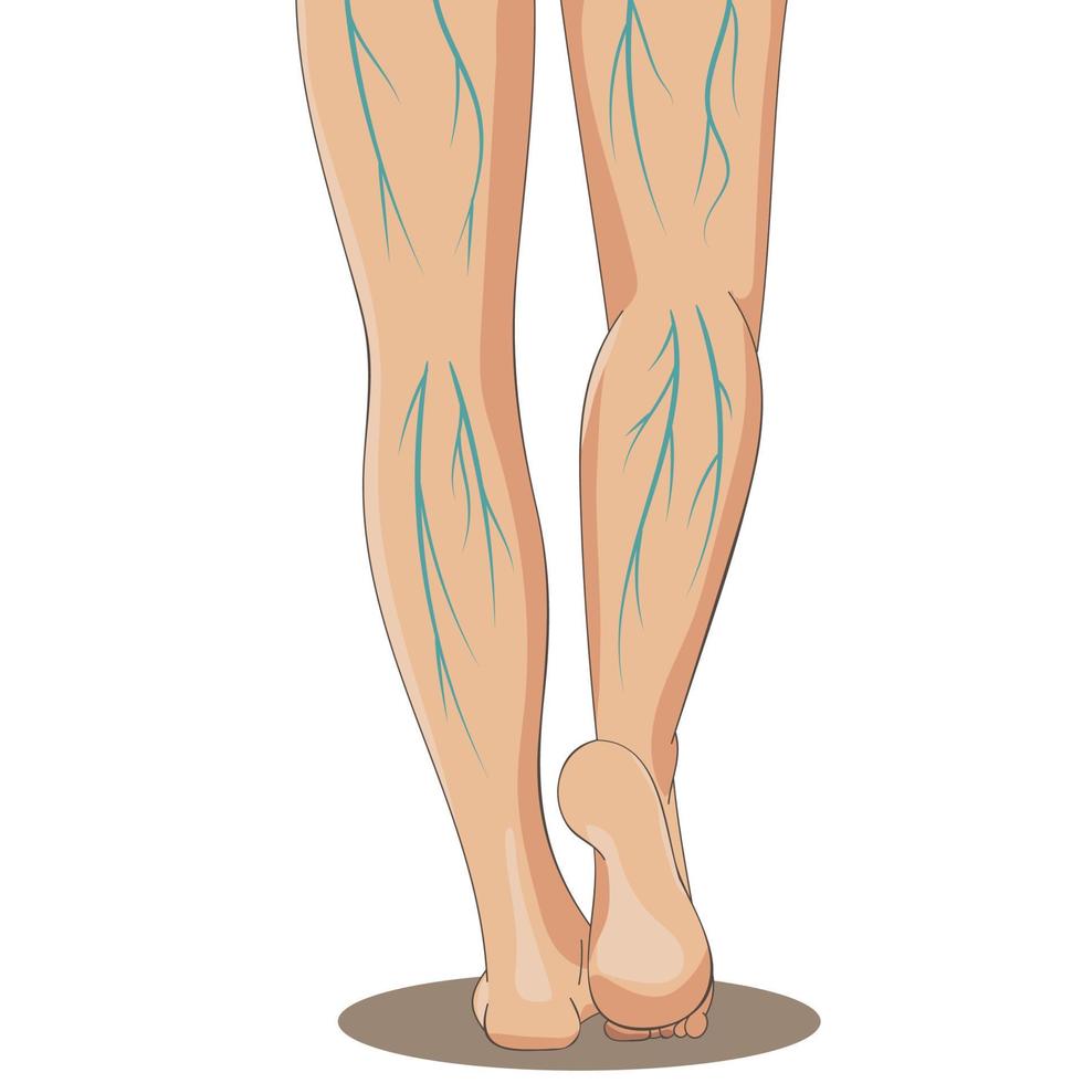 varicosidad. piernas femeninas, vista posterior, con varices vector