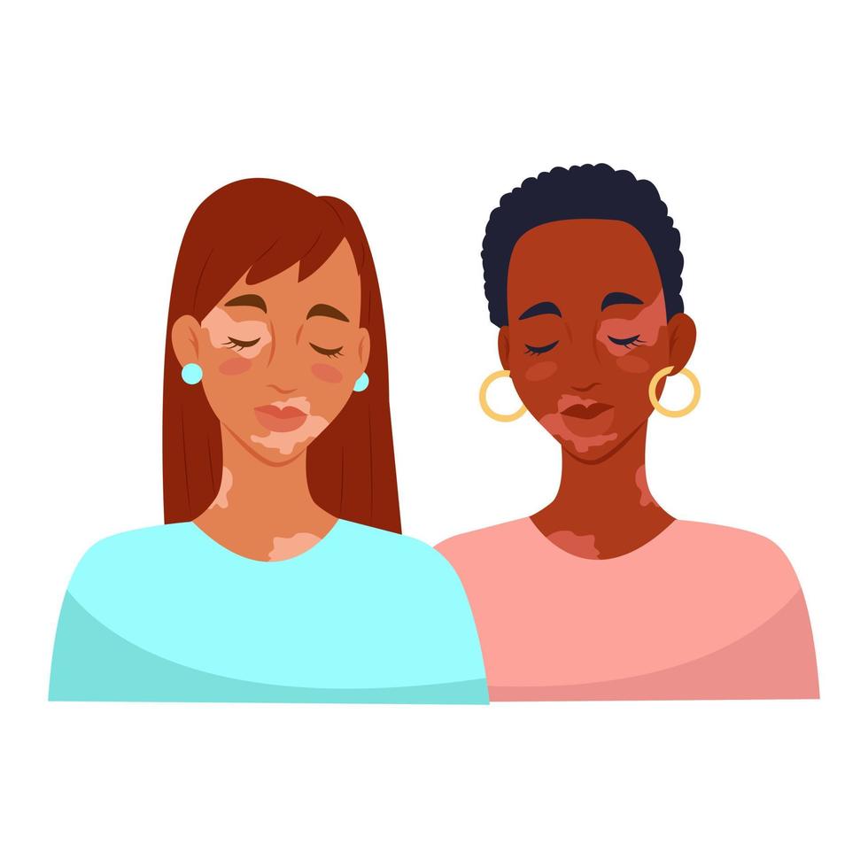 Two women with vitiligo. Vitiligo skin disease. Vector illustration