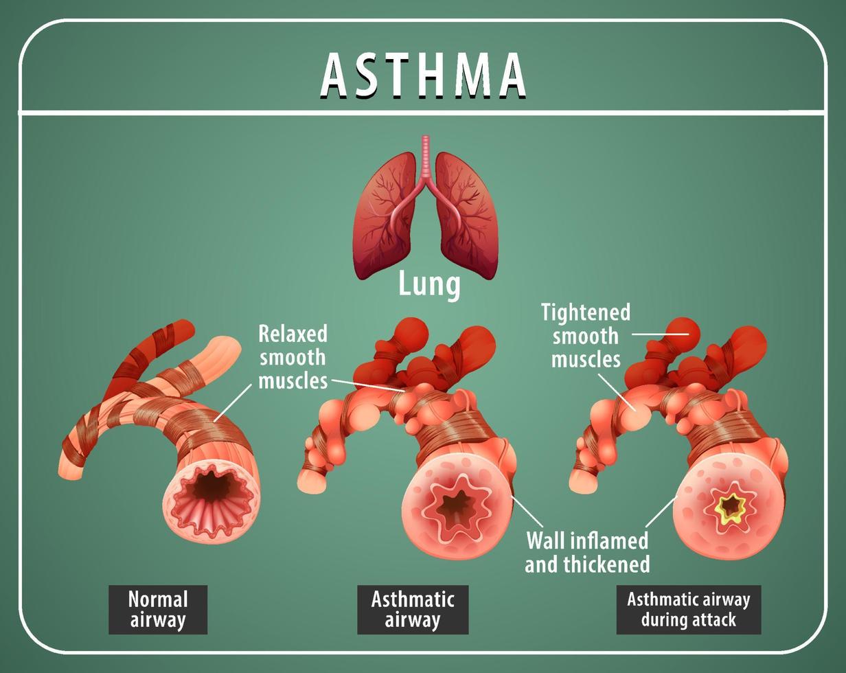 Asthma diagram with normal airway and asthmatic airway vector